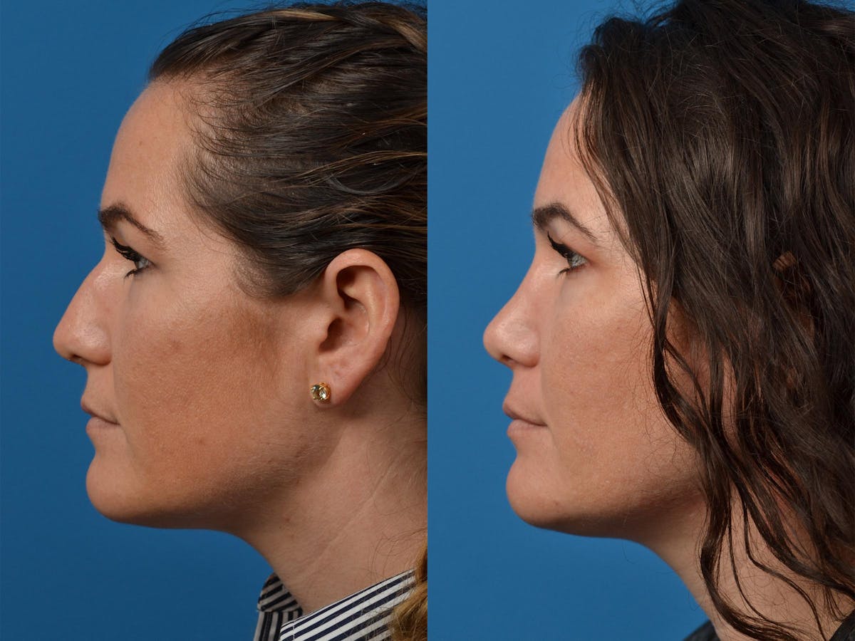 Rhinoplasty Before & After Gallery - Patient 122406854 - Image 5