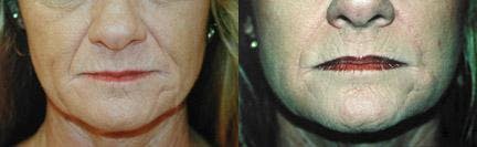 Lip Lift Before & After Gallery - Patient 122406855 - Image 1
