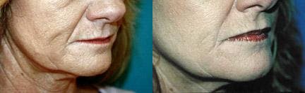 Lip Lift Before & After Gallery - Patient 122406855 - Image 2