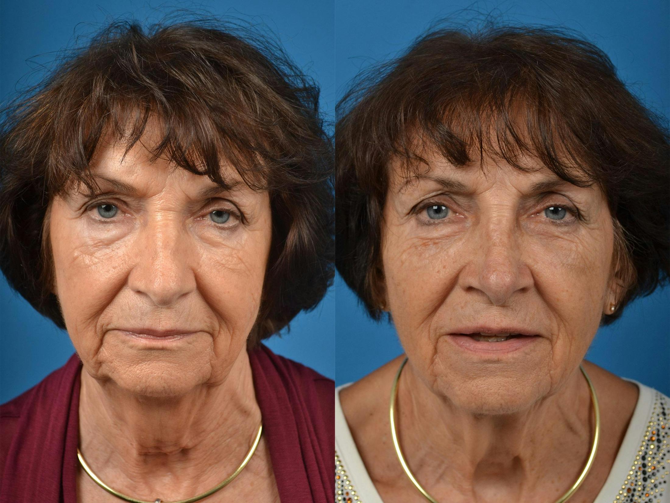 Rhinoplasty Before & After Gallery - Patient 122406864 - Image 1