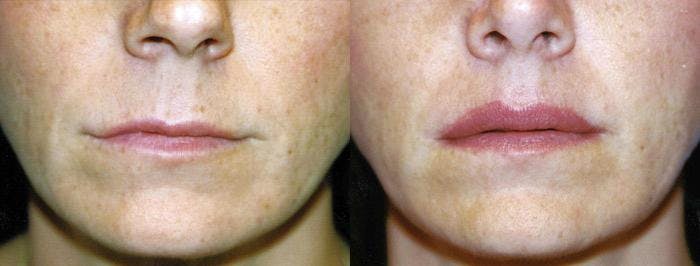 Lip Lift Before & After Gallery - Patient 122406857 - Image 1