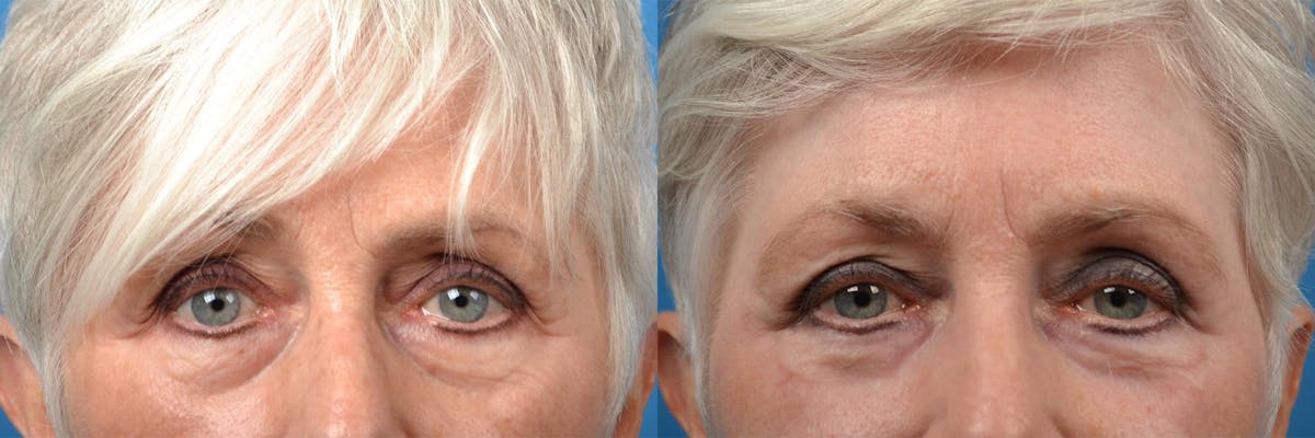 Skin Resurfacing Before & After Gallery - Patient 122406862 - Image 6