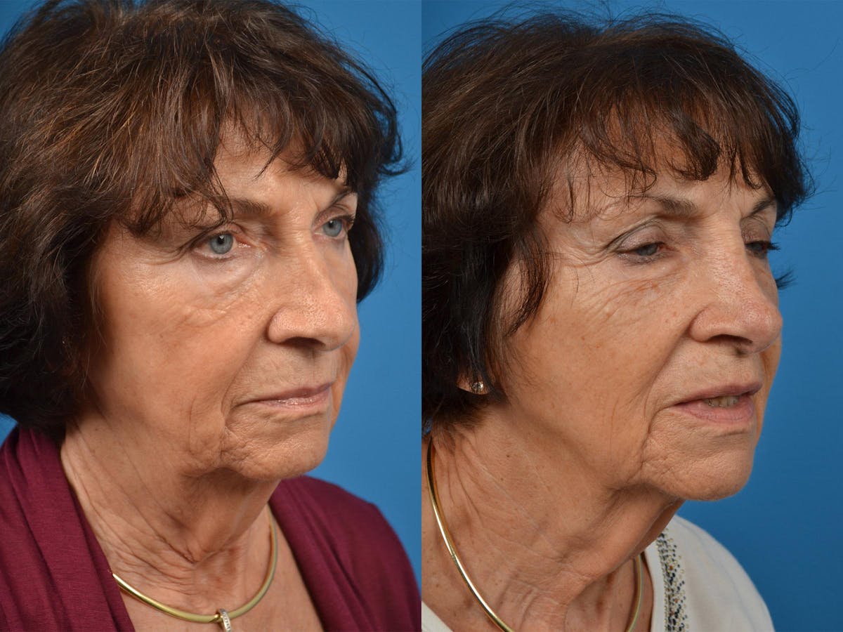 Rhinoplasty Before & After Gallery - Patient 122406864 - Image 2