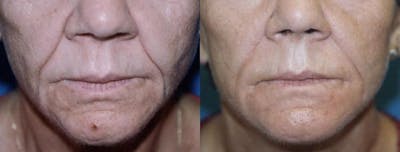Lip Lift Before & After Gallery - Patient 122406858 - Image 1