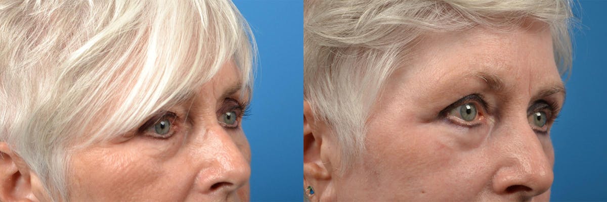 Skin Resurfacing Before & After Gallery - Patient 122406862 - Image 7