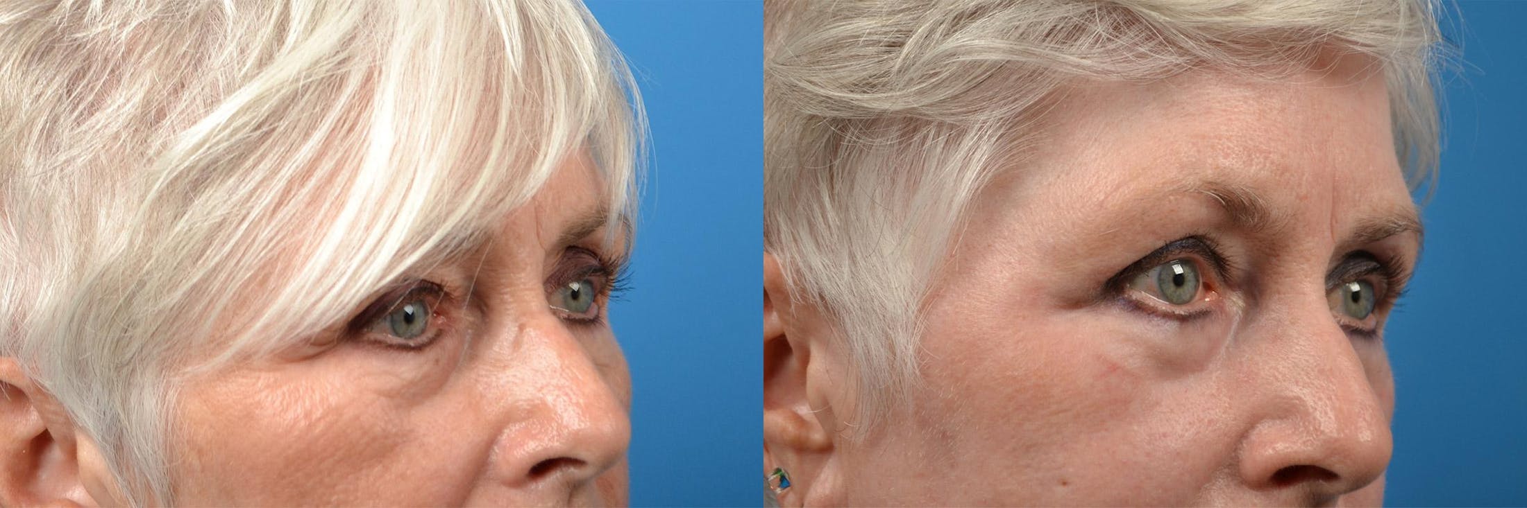 Skin Resurfacing Before & After Gallery - Patient 122406862 - Image 7