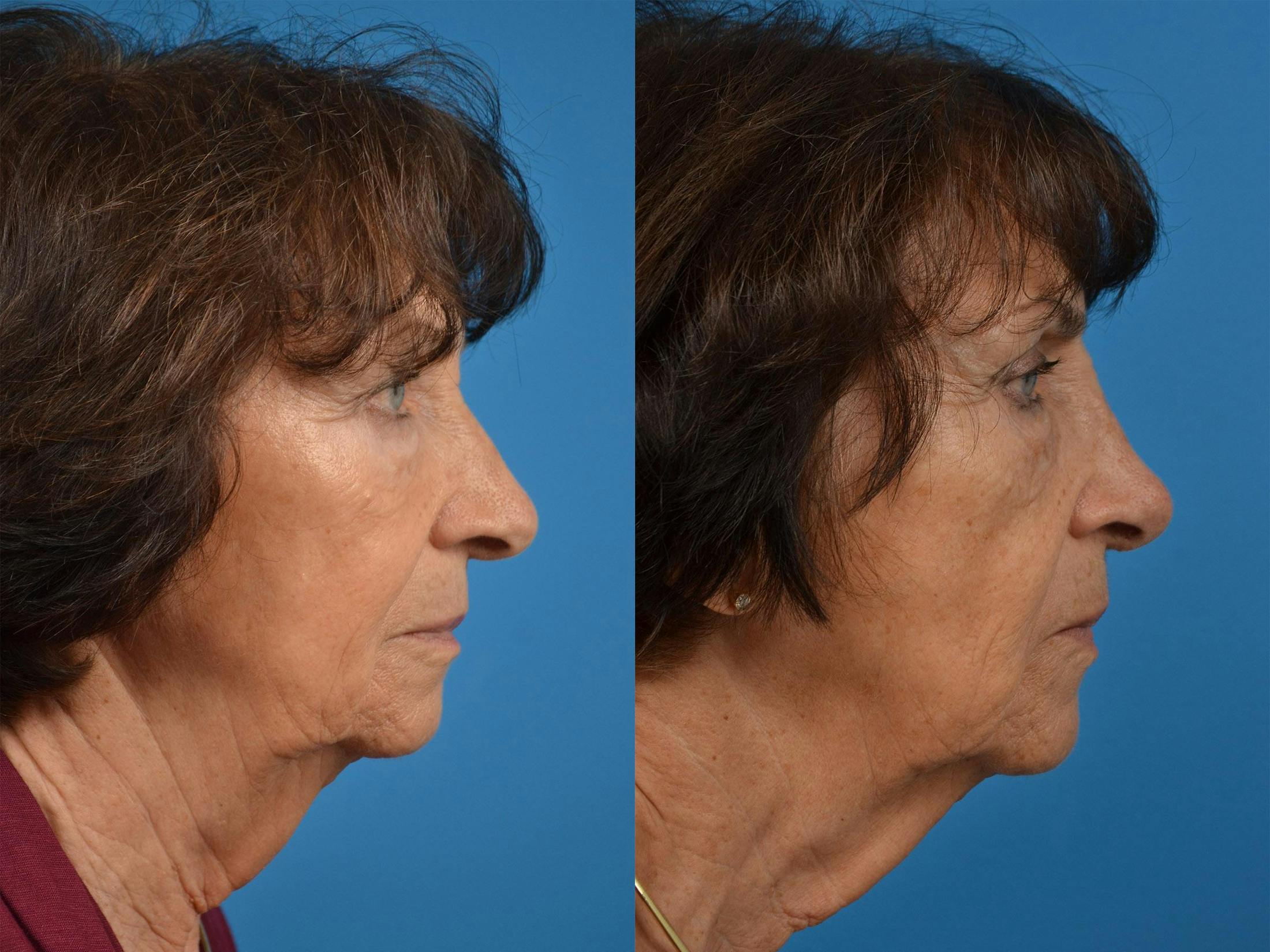 Rhinoplasty Before & After Gallery - Patient 122406864 - Image 3