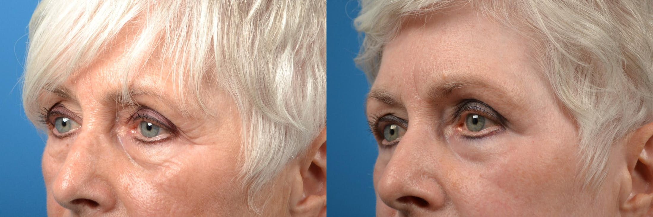 Skin Resurfacing Before & After Gallery - Patient 122406862 - Image 8