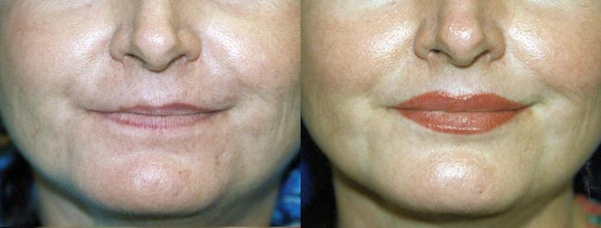 Lip Lift Before & After Gallery - Patient 122406860 - Image 1