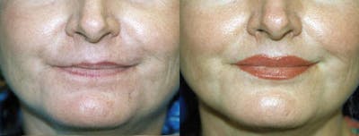 Lip Lift Before & After Gallery - Patient 122406860 - Image 1