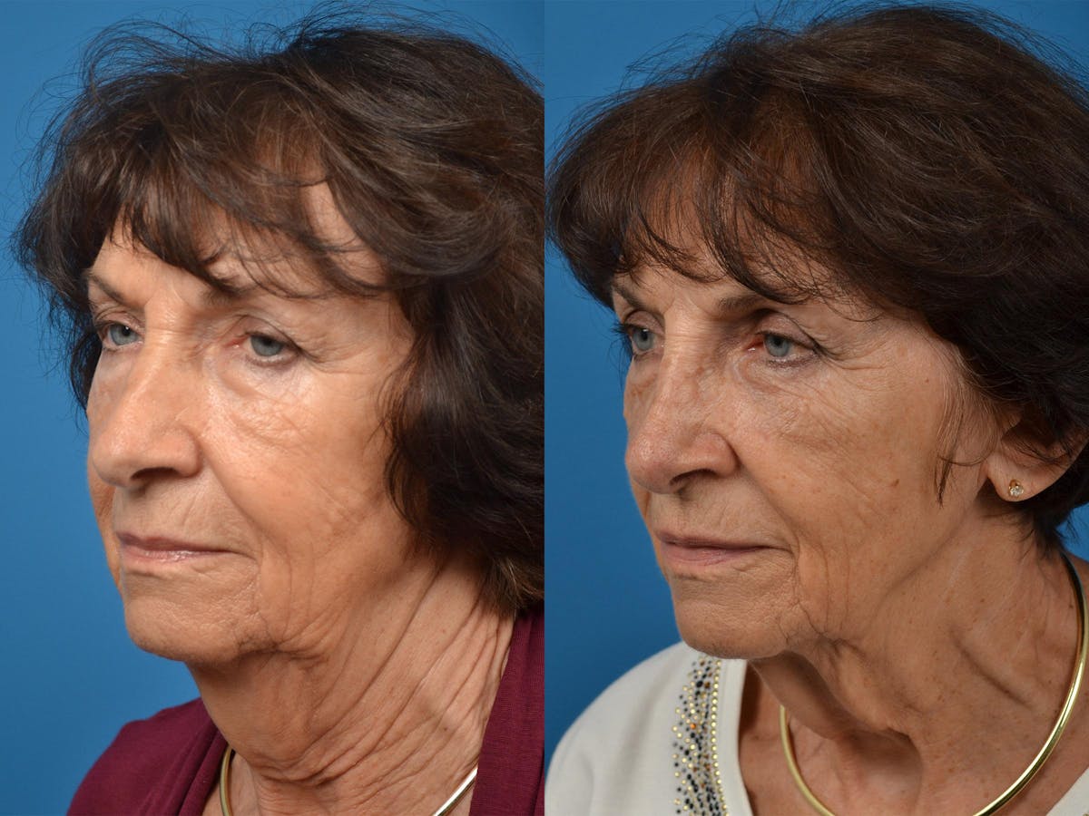 Rhinoplasty Before & After Gallery - Patient 122406864 - Image 4