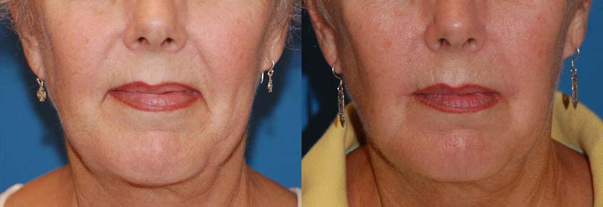 Lip Lift Before & After Gallery - Patient 122406861 - Image 1