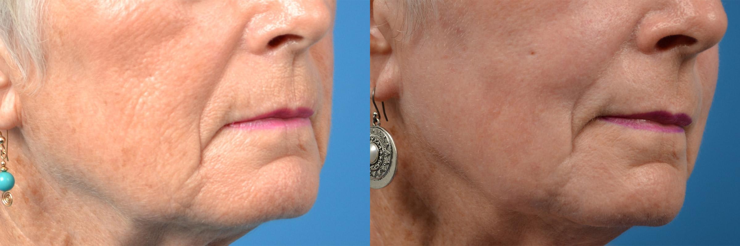 Skin Resurfacing Before & After Gallery - Patient 122406862 - Image 10