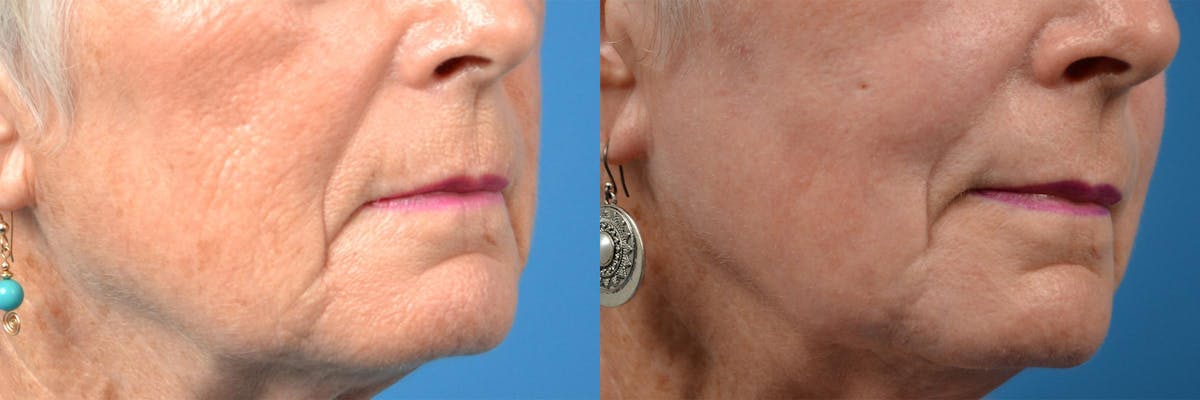Skin Resurfacing Before & After Gallery - Patient 122406862 - Image 10