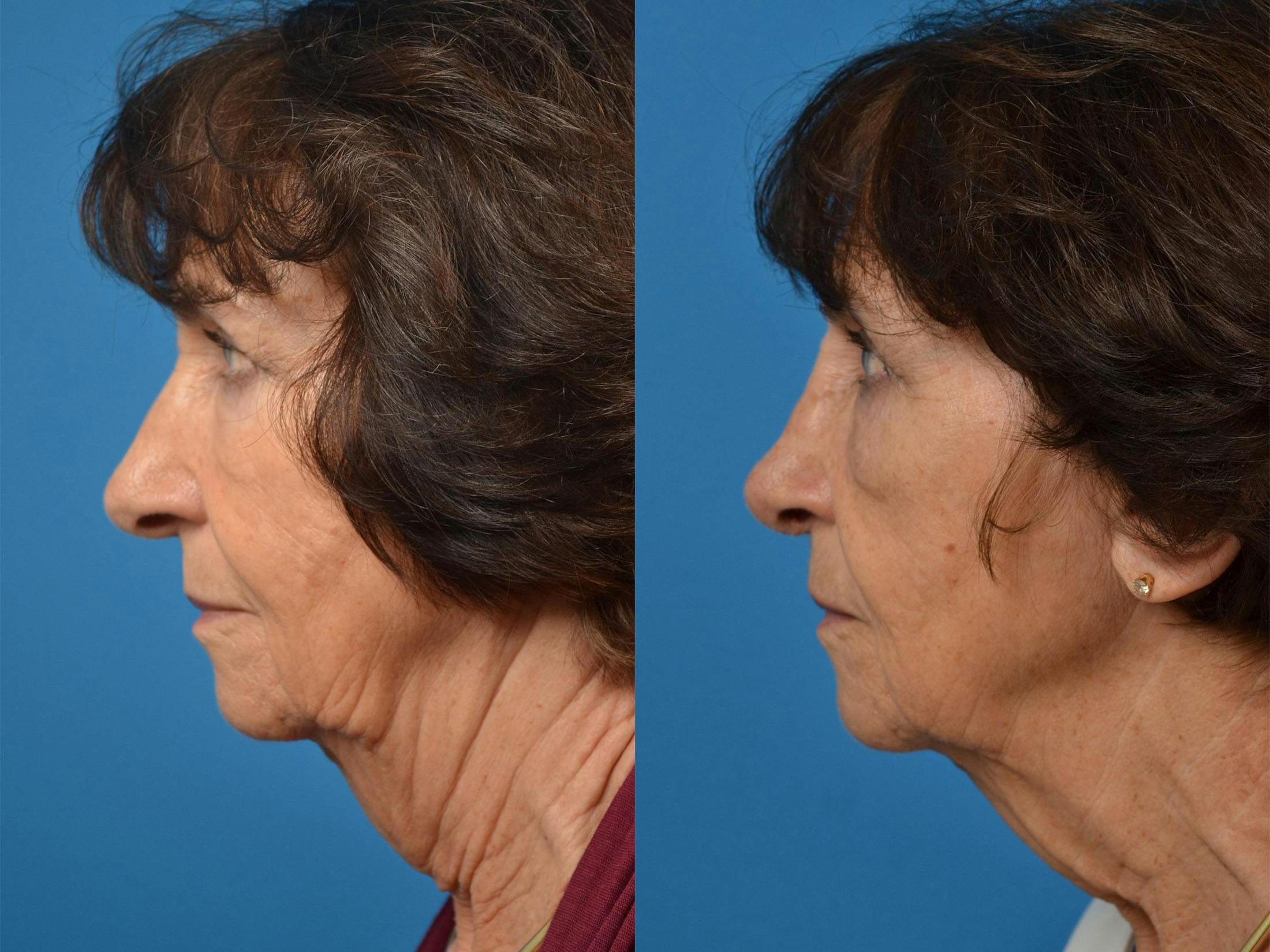 Rhinoplasty Before & After Gallery - Patient 122406864 - Image 5