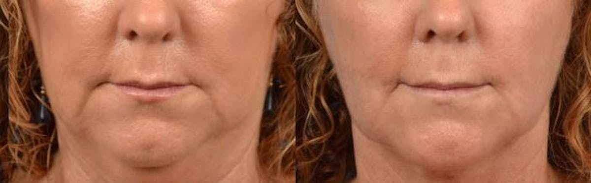 Lip Lift Before & After Gallery - Patient 122406863 - Image 1