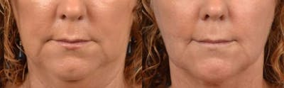 Lip Lift Before & After Gallery - Patient 122406863 - Image 1