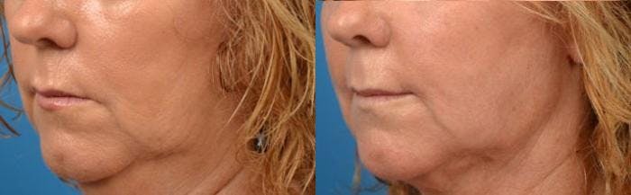 Lip Lift Before & After Gallery - Patient 122406863 - Image 2