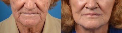 Lip Lift Before & After Gallery - Patient 122406865 - Image 1