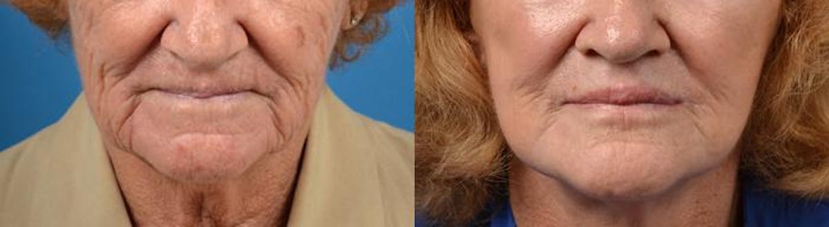 Lip Lift Before & After Gallery - Patient 122406865 - Image 1