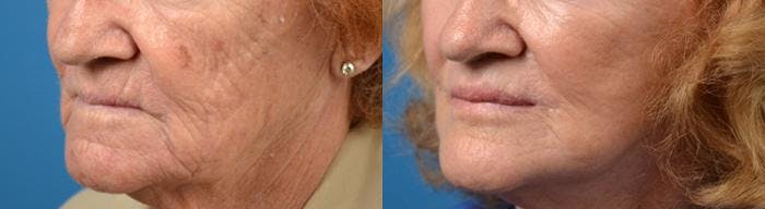 Lip Lift Before & After Gallery - Patient 122406865 - Image 2