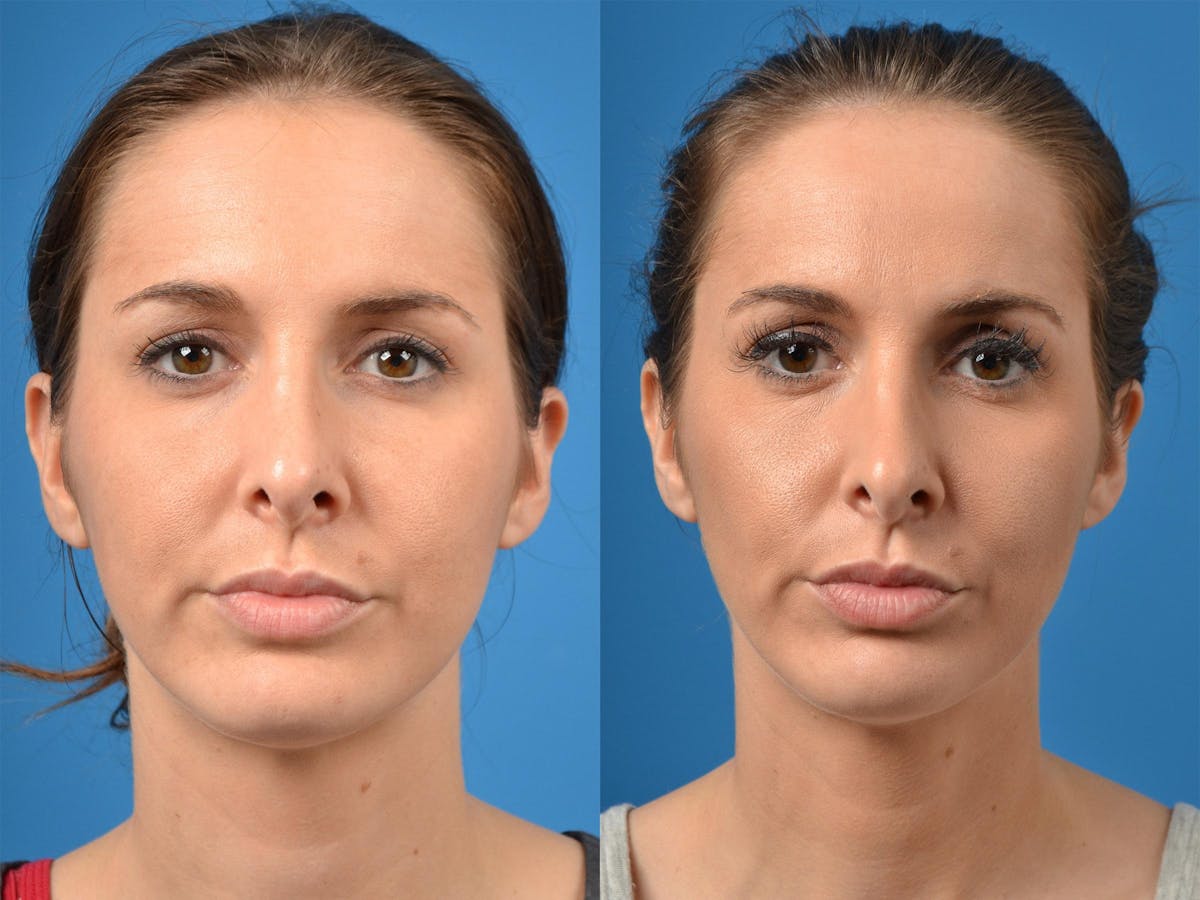 Rhinoplasty Before & After Gallery - Patient 122406870 - Image 1