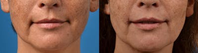 Lip Lift Before & After Gallery - Patient 122406867 - Image 1
