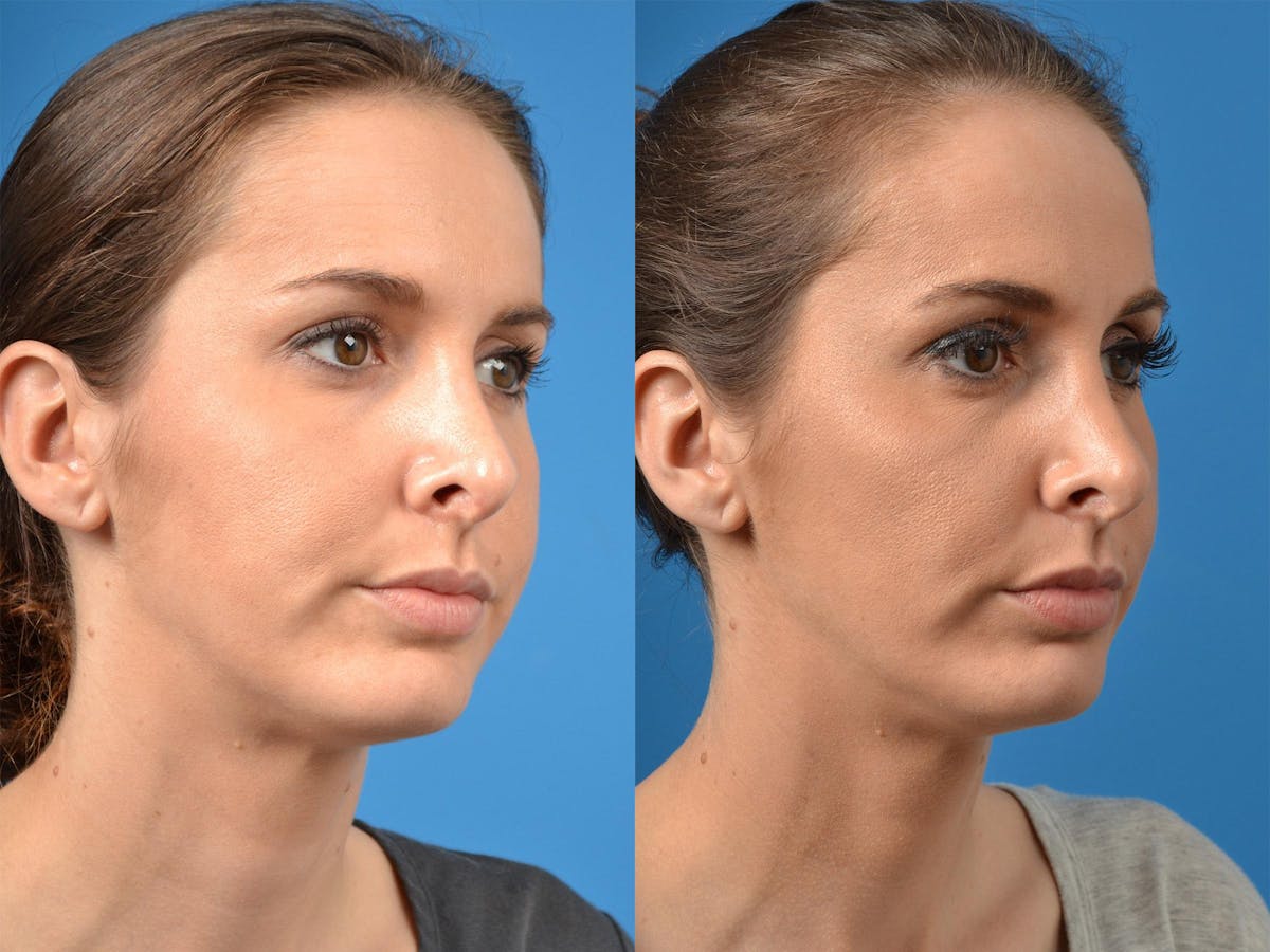 Rhinoplasty Before & After Gallery - Patient 122406870 - Image 2