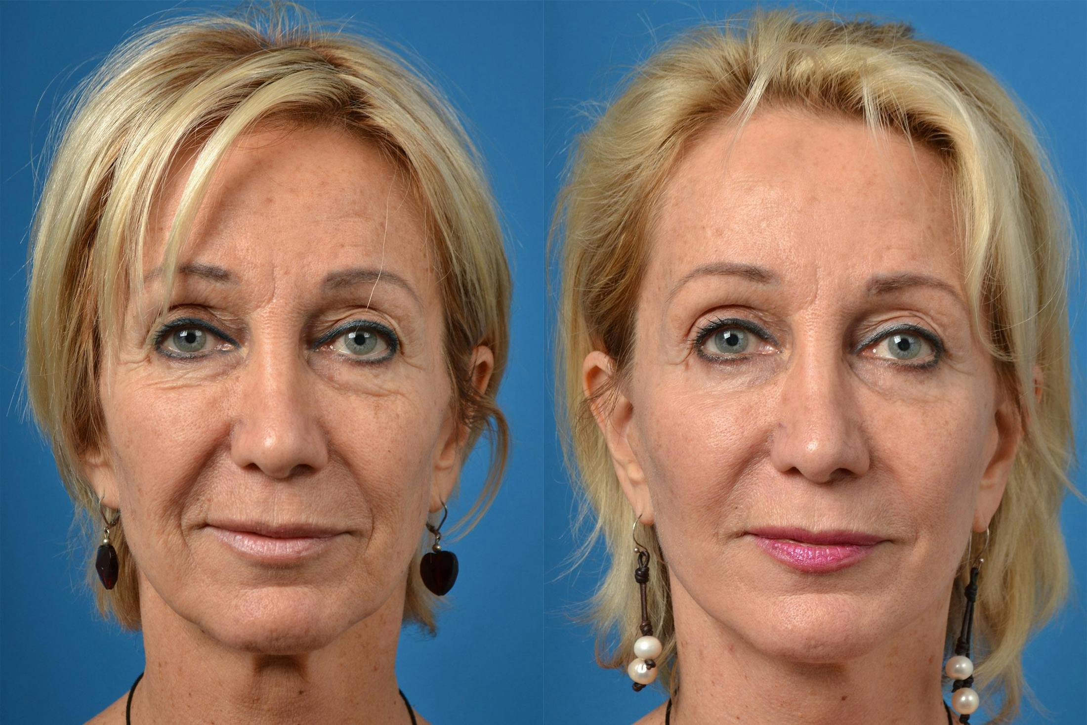 Skin Resurfacing Before & After Gallery - Patient 122406869 - Image 1