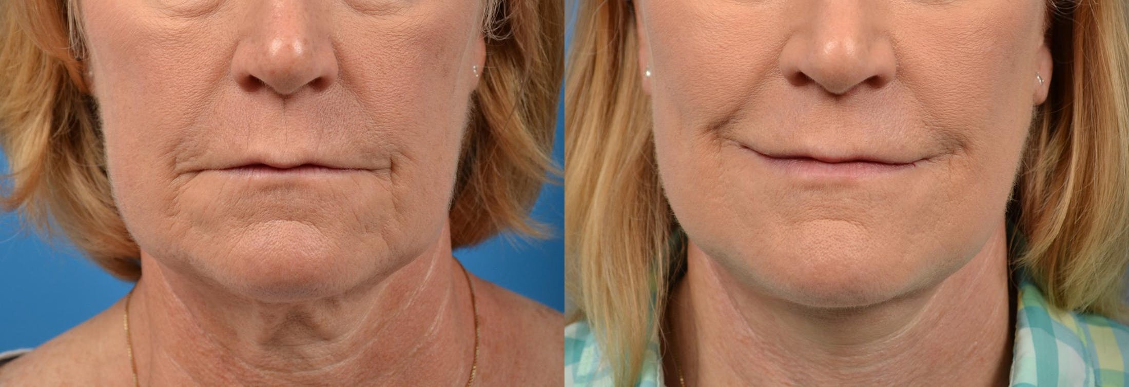 Lip Lift Before & After Gallery - Patient 122406868 - Image 1
