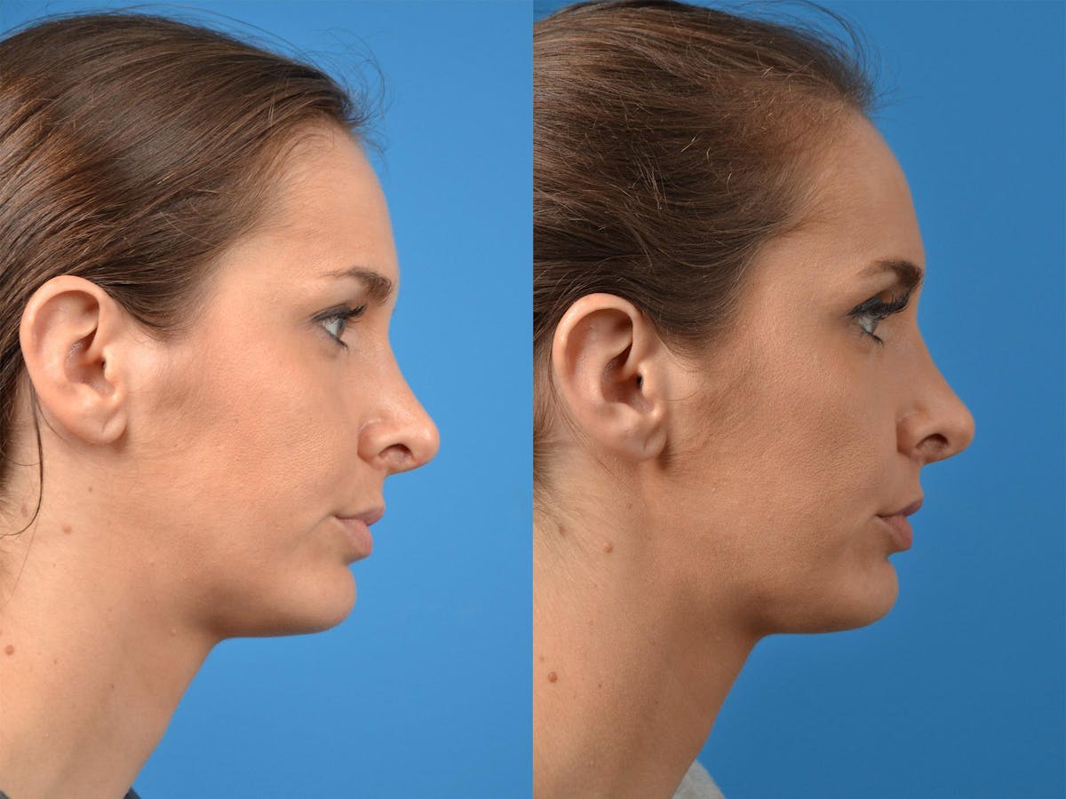 Rhinoplasty Before & After Gallery - Patient 122406870 - Image 3