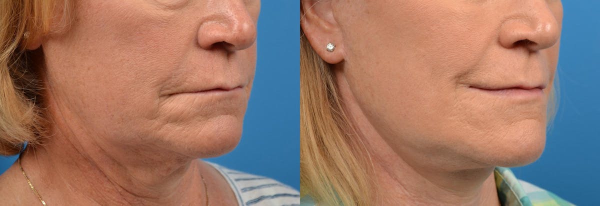 Lip Lift Before & After Gallery - Patient 122406868 - Image 2
