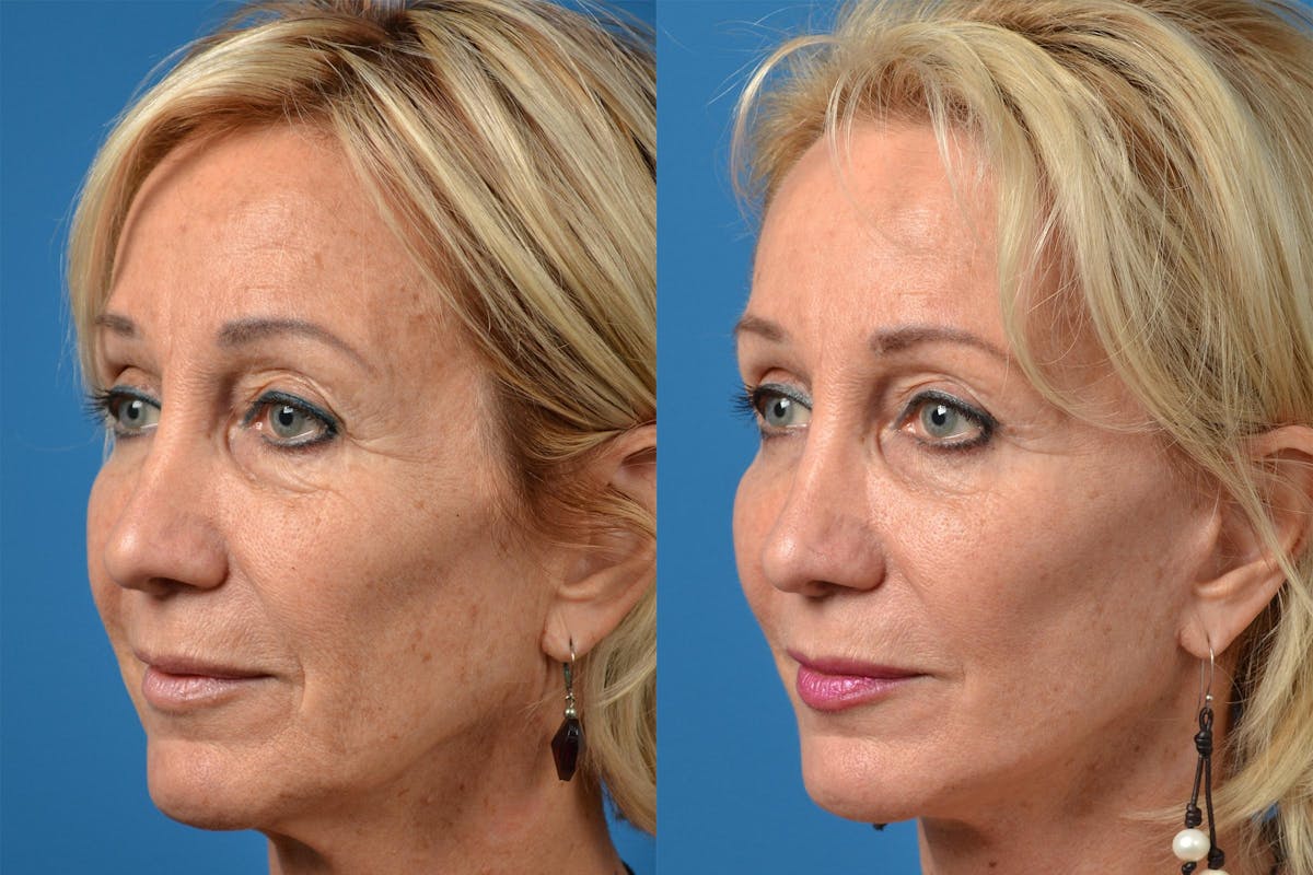 Skin Resurfacing Before & After Gallery - Patient 122406869 - Image 2
