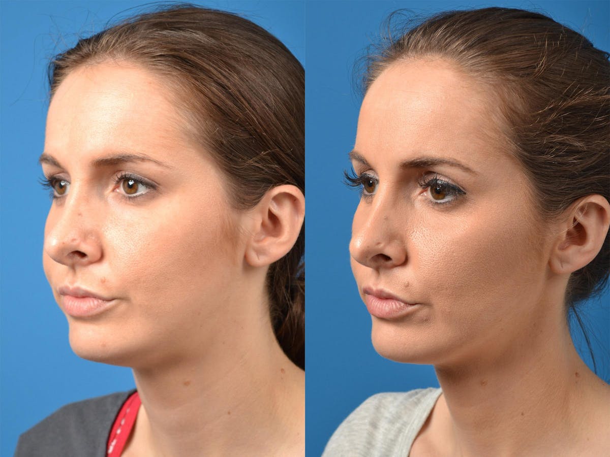 Rhinoplasty Before & After Gallery - Patient 122406870 - Image 4