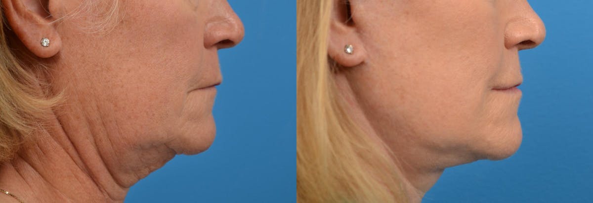 Lip Lift Before & After Gallery - Patient 122406868 - Image 3