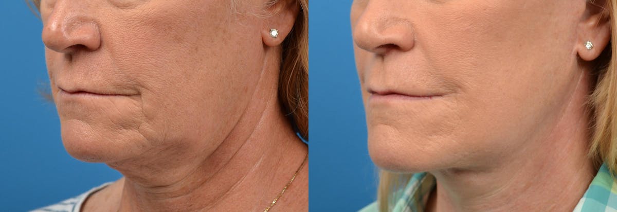Lip Lift Before & After Gallery - Patient 122406868 - Image 4