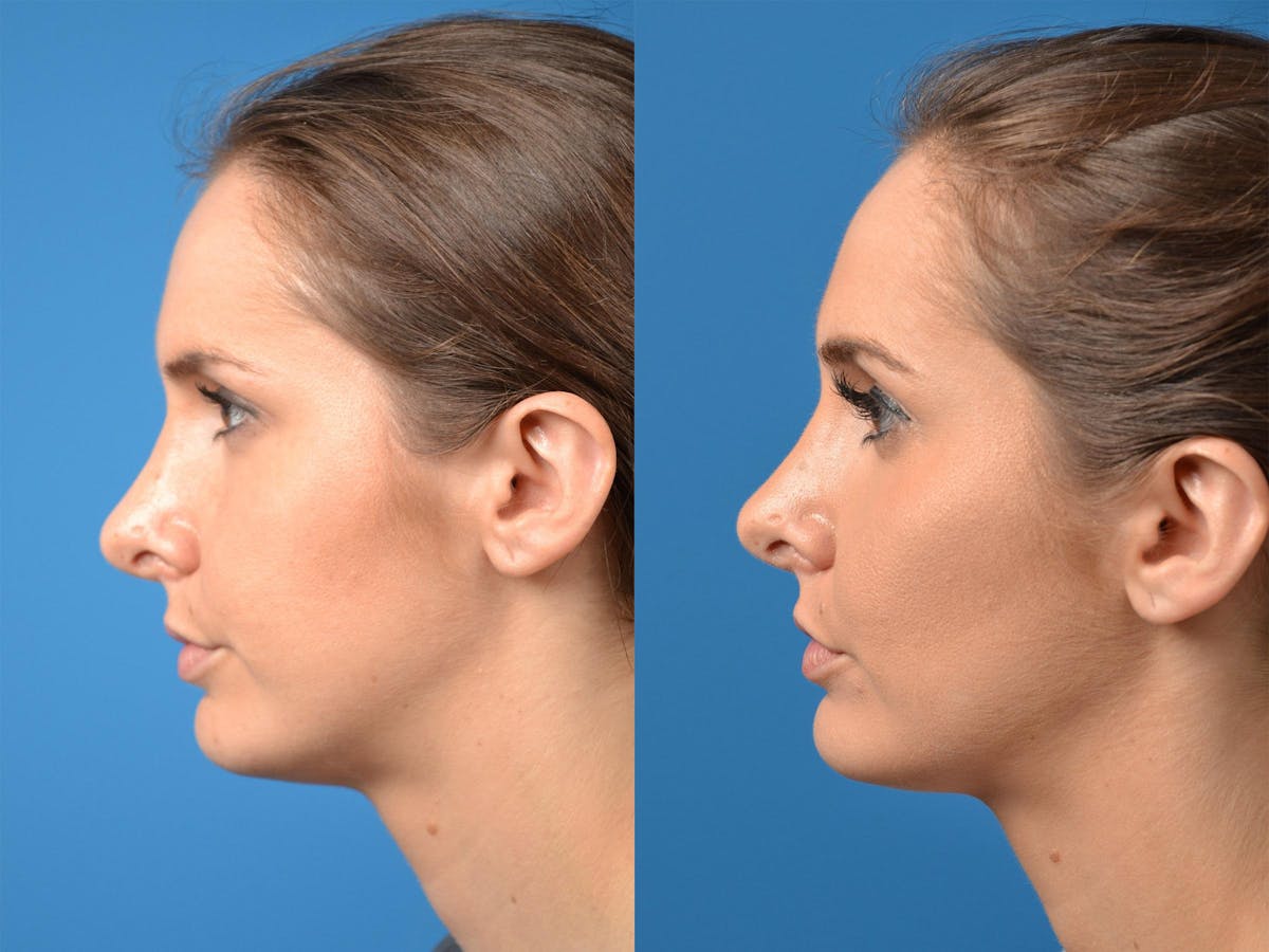 Rhinoplasty Before & After Gallery - Patient 122406870 - Image 5