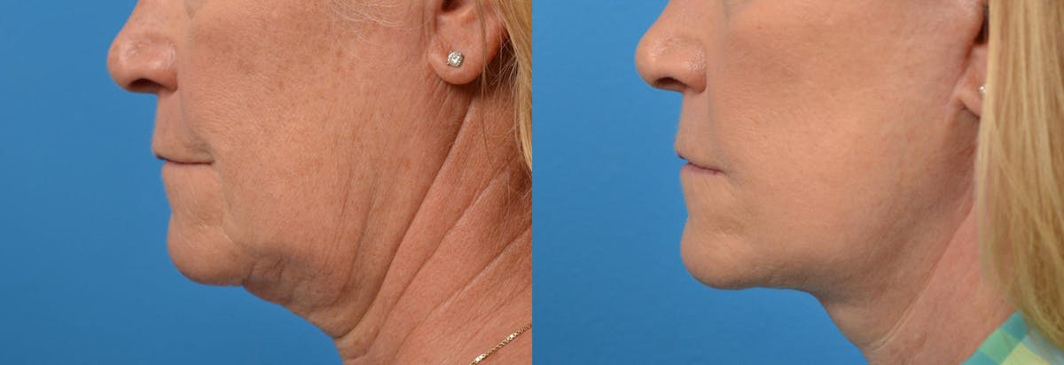 Lip Lift Before & After Gallery - Patient 122406868 - Image 5