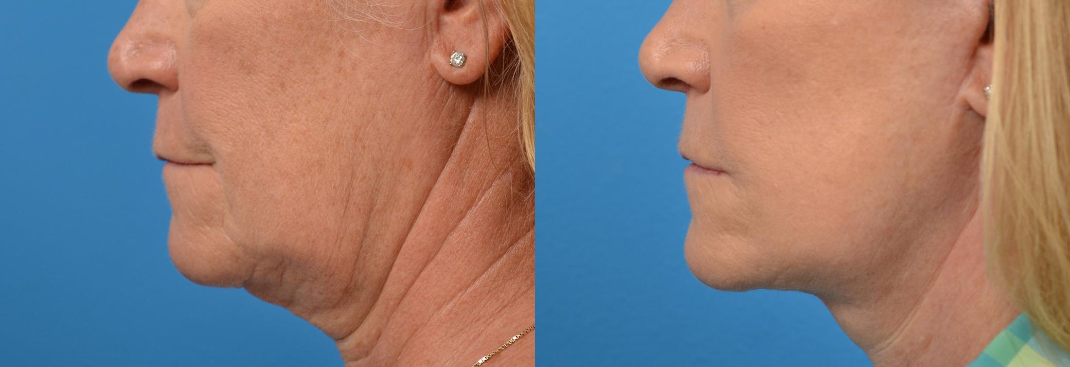 Lip Lift Before & After Gallery - Patient 122406868 - Image 5