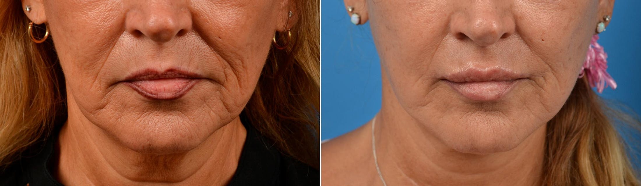 Lip Lift Before & After Gallery - Patient 122406871 - Image 1