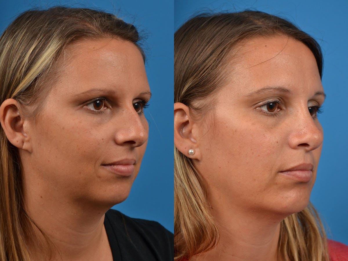 Rhinoplasty Before & After Gallery - Patient 122406872 - Image 1