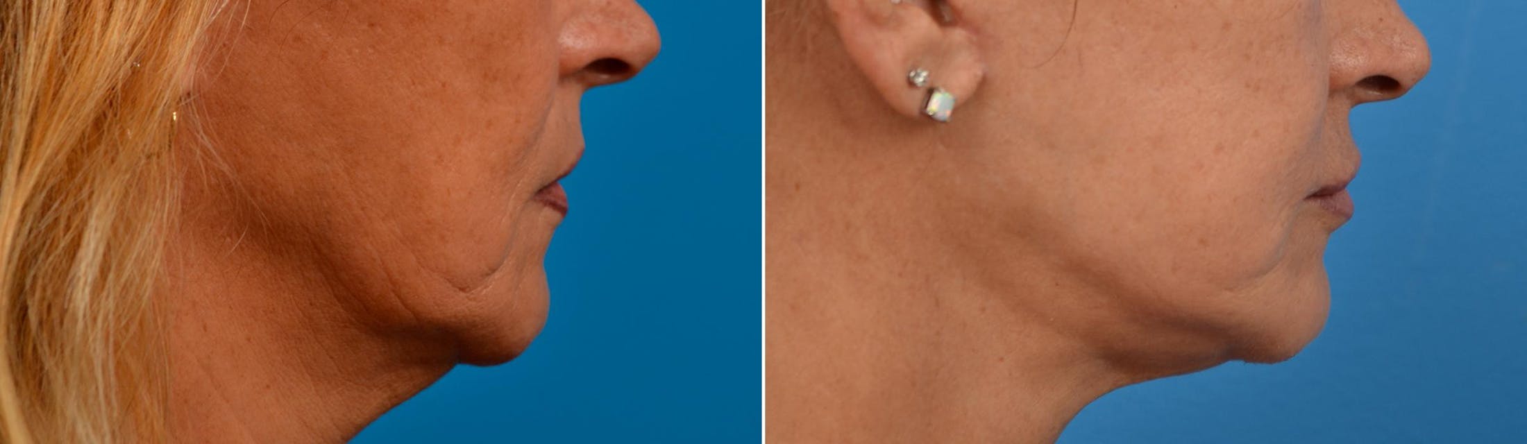 Lip Lift Before & After Gallery - Patient 122406871 - Image 2