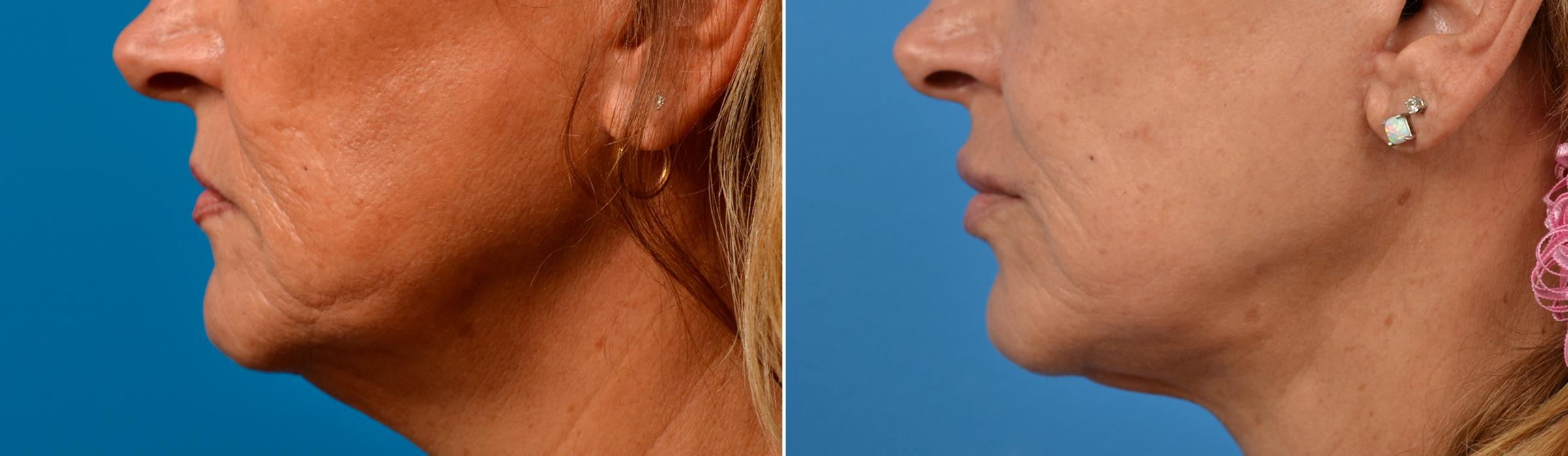 Lip Lift Before & After Gallery - Patient 122406871 - Image 3
