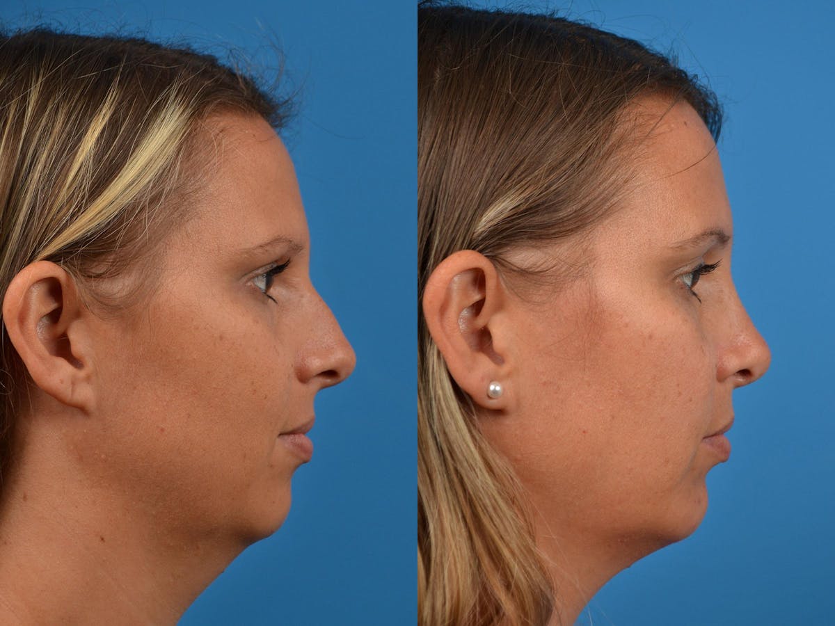 Rhinoplasty Before & After Gallery - Patient 122406872 - Image 2