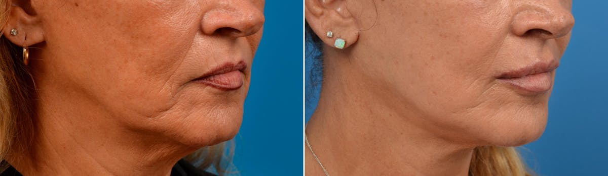 Lip Lift Before & After Gallery - Patient 122406871 - Image 4