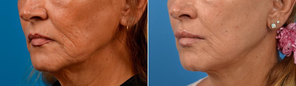Lip Lift Before & After Gallery - Patient 122406871 - Image 5