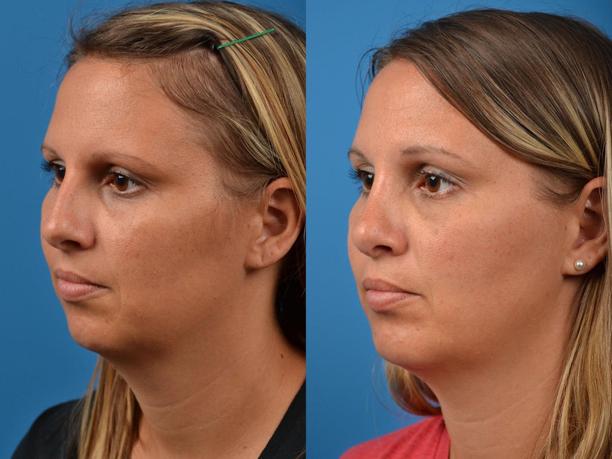 Rhinoplasty Before & After Gallery - Patient 122406872 - Image 3