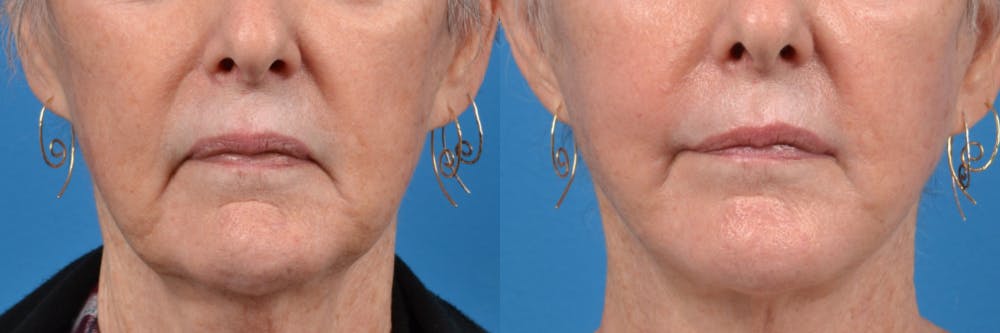Lip Lift Before & After Gallery - Patient 122406874 - Image 1
