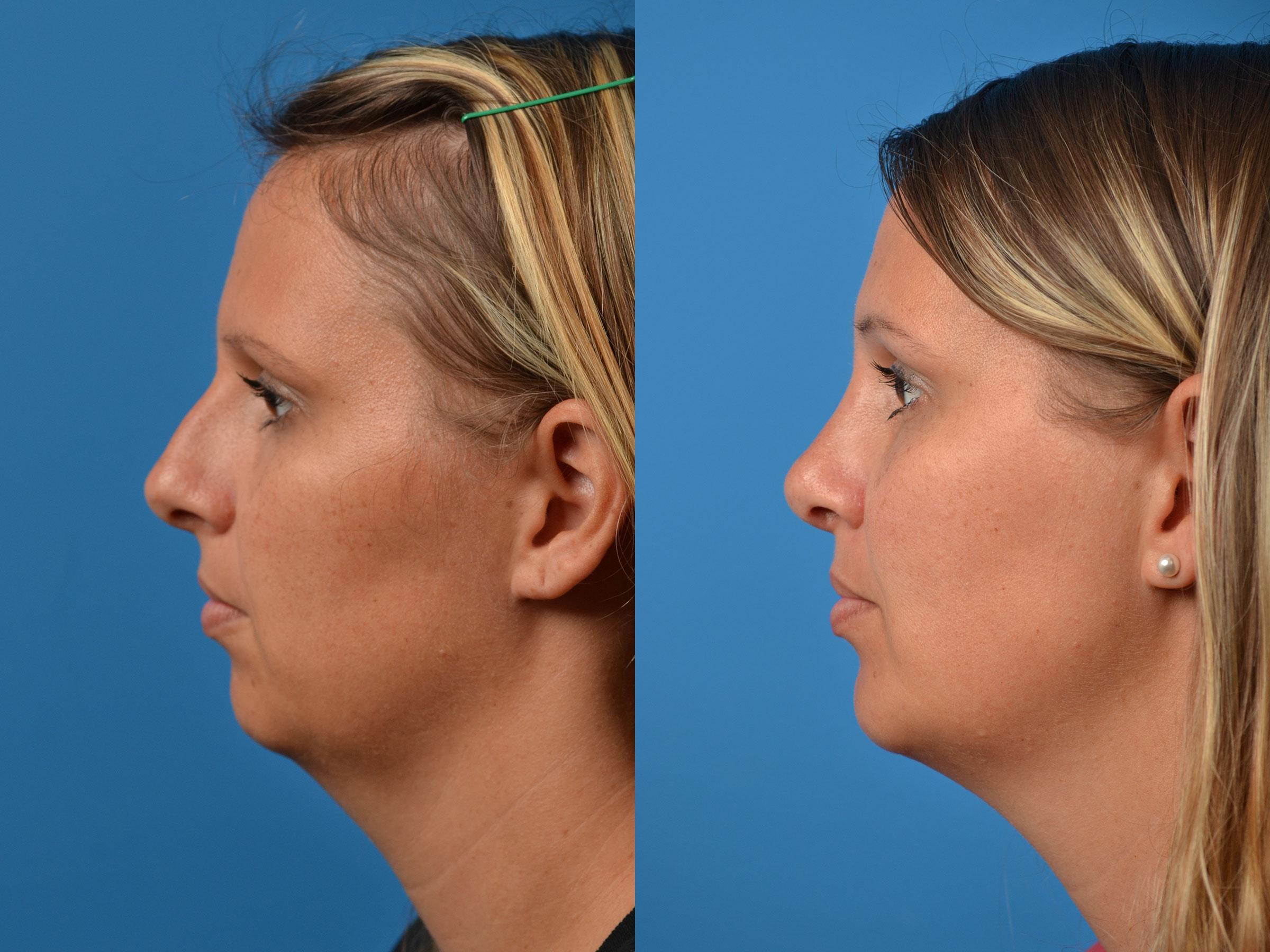 Rhinoplasty Before & After Gallery - Patient 122406872 - Image 4