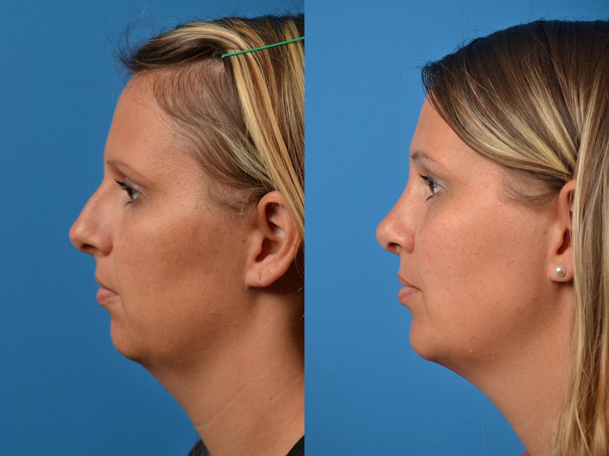 Rhinoplasty Before & After Gallery - Patient 122406872 - Image 4